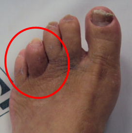 Sequestro ósseo no pé