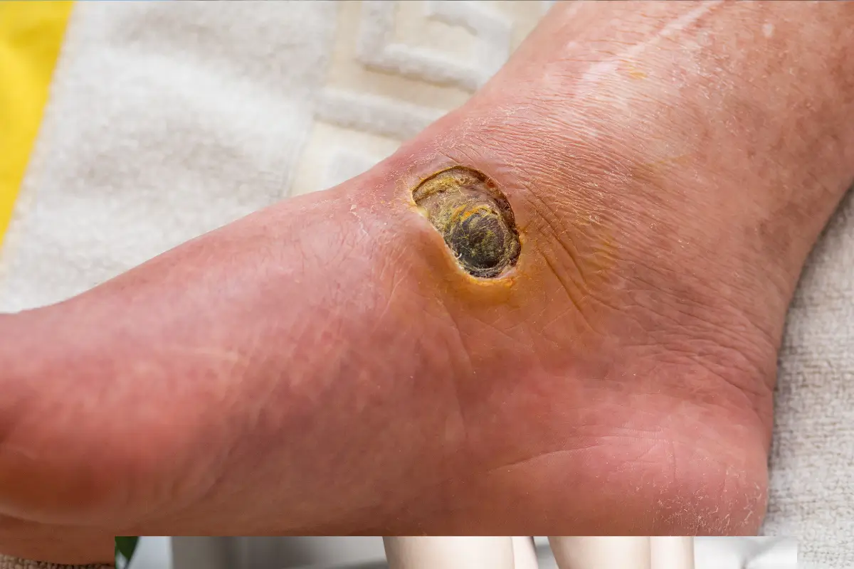 feridas pé diabético