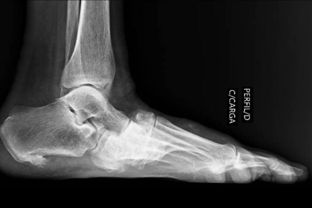 artropatia de charcot