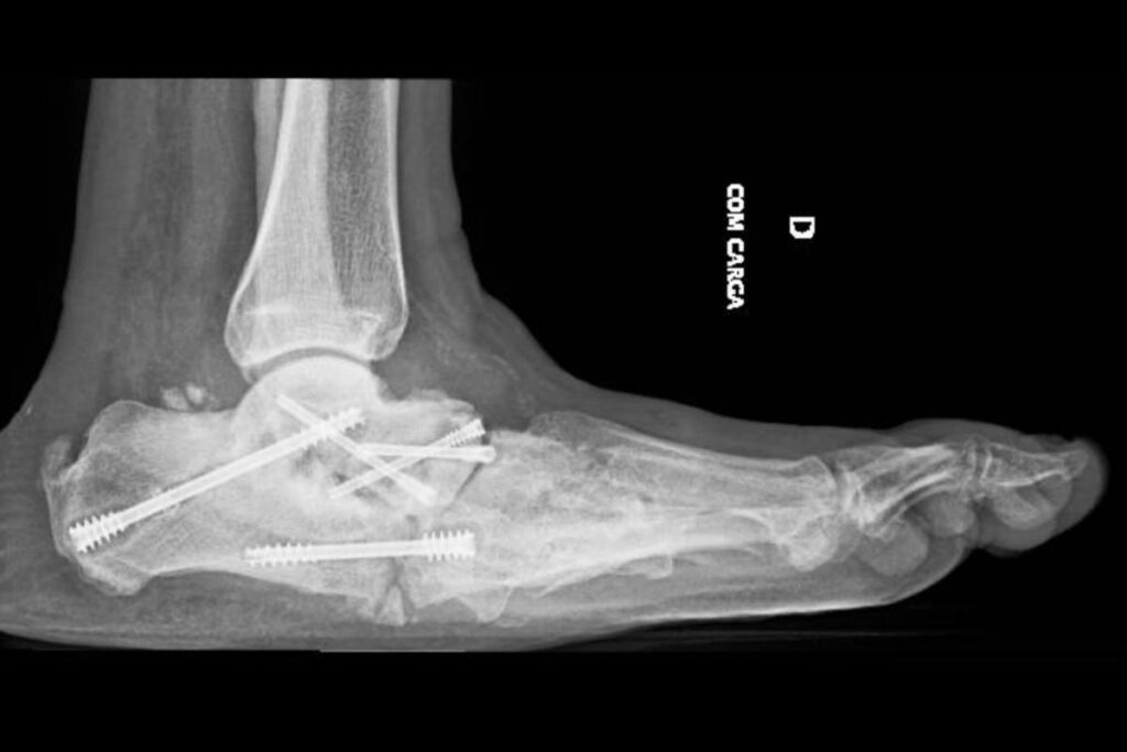 Artropatia de Charcot