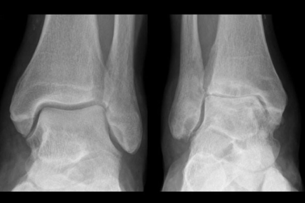 Artropatia de Charcot