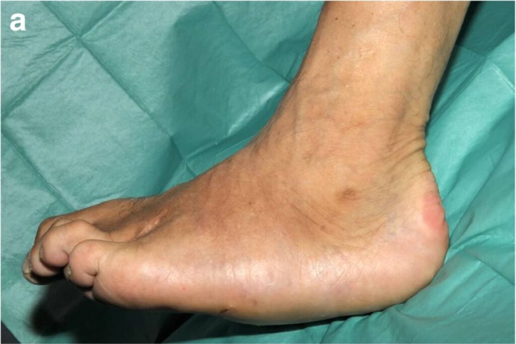 artropatia de charcot