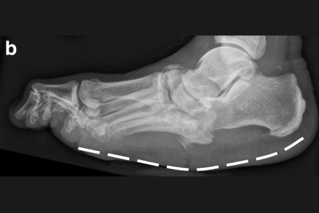 Artropatia-de-Charcot